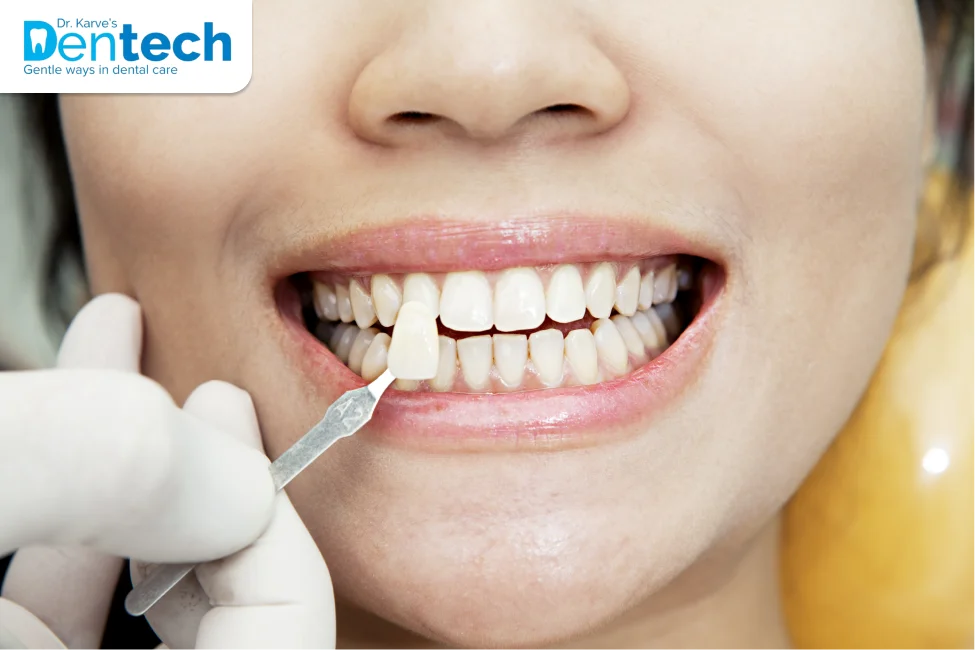 SMILE DESIGN - Dr. Karve's Dentech